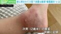 蚊に刺されて入院? 放置厳禁の「蜂窩織炎」とは? 転倒・靴ずれ・クラゲもきっかけに