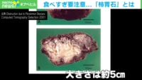 原因は“柿の食べ過ぎ”? 体内にできた「柿胃石」