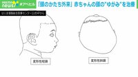 【映像】頭の形専門外来とは？ 実際の治療法を解説