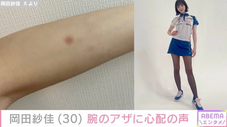 【写真・画像】“役満ボディー”岡田紗佳(30) 腕のアザに心配の声「痛々しいお大事に」「大事なお肌が…」 2枚目