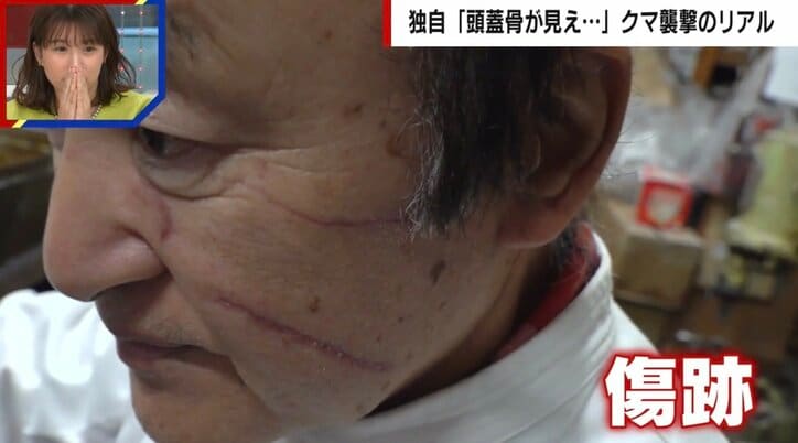 「頭蓋骨が開いてた。もう死ぬんだなと」クマ被害者を独自取材　頭は30針以上の怪我、耳たぶを噛みちぎられ、あと5mmで失明の恐れも…被害者が語った「恐怖の瞬間」