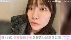 あいのり桃、「3度目の正直」美容整形手術を報告し経過を公開「もうすでに形が可愛い気がする」