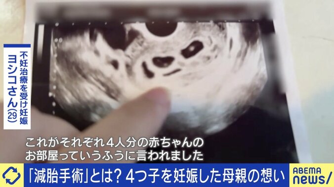 4つ子を妊娠で“減胎手術”