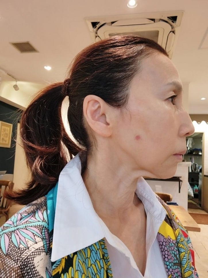  武東由美、顔の傷を診てもらった皮膚科で2度驚かれたこと「思っていたより傷深い」 
