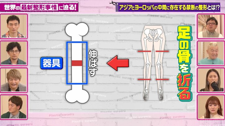 【写真・画像】31歳イケメン医師、 “骨延長手術”で身長167cm→177cmに「モテるようになりました」費用も公開 3枚目