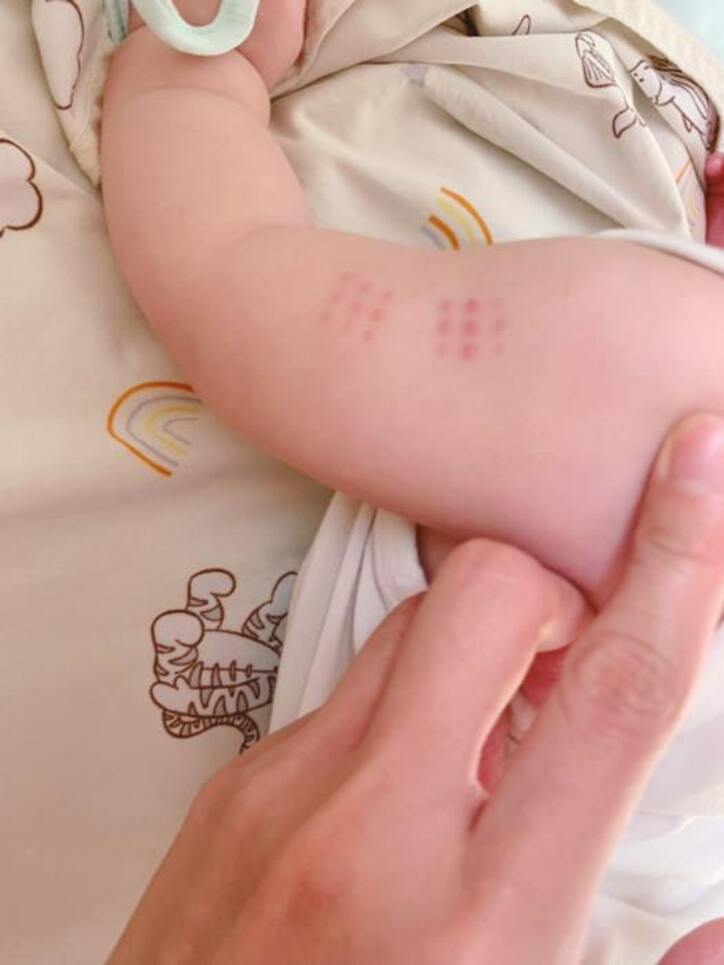  最上もが、BCGワクチン接種後の娘の経過を報告「ちょい赤みが強くなってきて」 