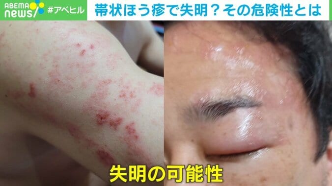 帯状疱疹で失明？ 疲れとストレスがトリガーに 2枚目