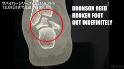 負傷の深刻さを物語るレントゲン写真