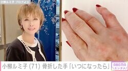 小柳ルミ子、骨折した右手にファンから心配の声「痛々しいですね」