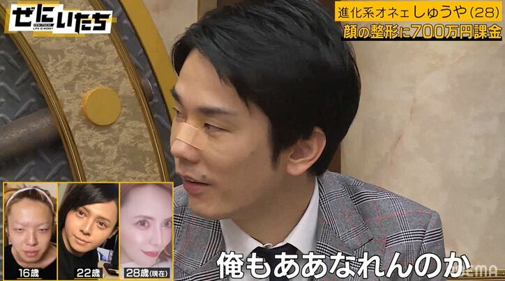 整形に700万課金、衝撃のビフォーアフター写真にかまいたち濱家「俺もああなれんのか」