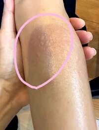 尾形あい『寒冷蕁麻』