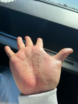  あいのり・クロ、自身の手に出ている辛い症状を明かす「セカンドオピニオンも受けてみようかな」 