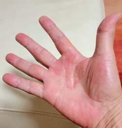  モト冬樹、手の症状が続き皮膚科を受診「早く治るといいな」 