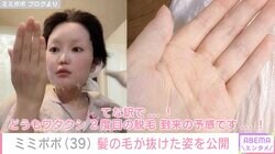 “34歳で余命宣告”ミミポポ（39）、抗がん剤治療の副作用を報告「めっちゃ髪の毛抜ける...！」