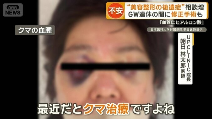 クマの血腫