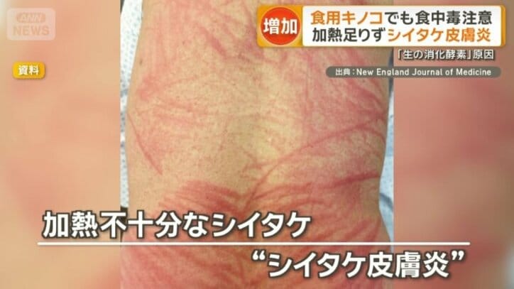 発疹が現れる「シイタケ皮膚炎」