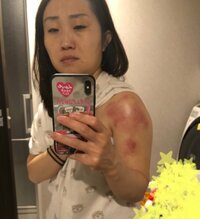 キンタロー。『ビタミンD注射の落とし穴～？』