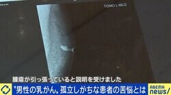 女性だけでない“男性乳がん”、発症者が語る戸惑いと早期発見の重要性 医師「乳腺があるからなる、と知って」 セルフチェック方法は？