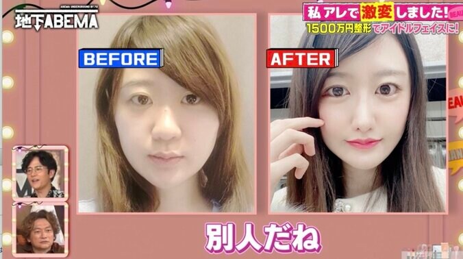 【写真・画像】1500万円でアイドル顔を手にいれた美女、骨切りダウンタイム中の姿に驚きの声「いつ人間に戻れるのか不安でした」　2枚目