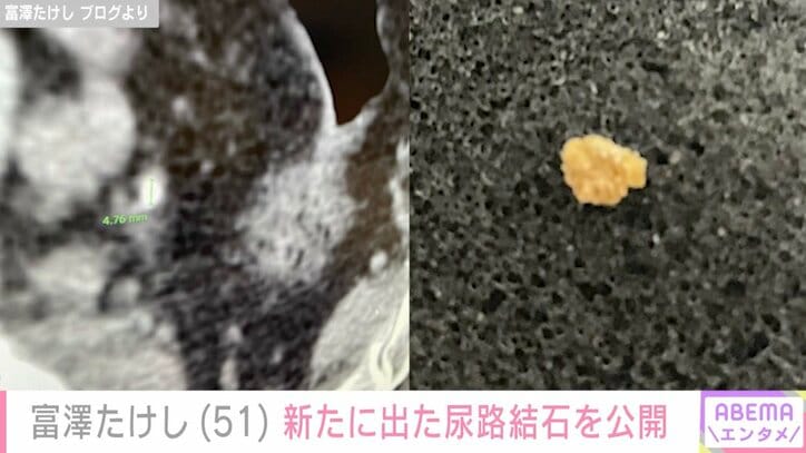 【写真・画像】サンド富澤、“恒例行事”の新たな尿路結石を公開「腰の痛みと血尿で動き始めたな」　2枚目