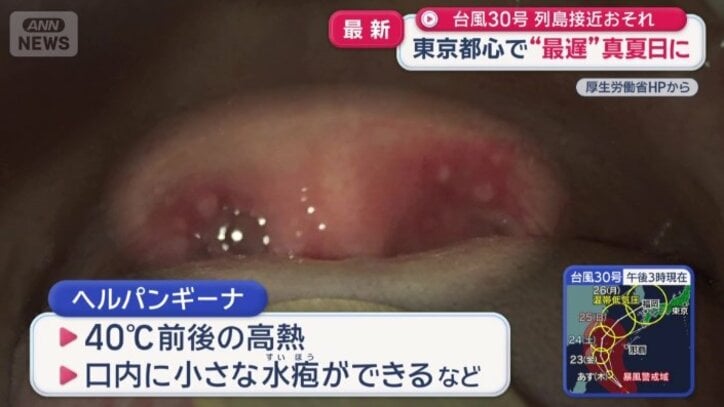ヘルパンギーナとは