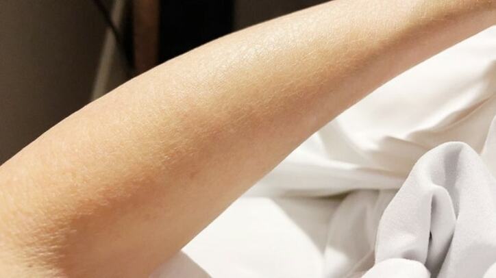  アグネス・チャン、湿疹が出て真っ赤に腫れ上がっていた両腕「食べ物のせいなのか、空気なのか」 