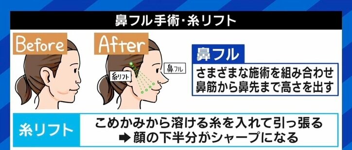 「“加工の顔にしたい”の希望が多い」 写真アプリを現実に？ 17歳少女の整形手術を断った美容外科医が“SNSの闇”に訴え