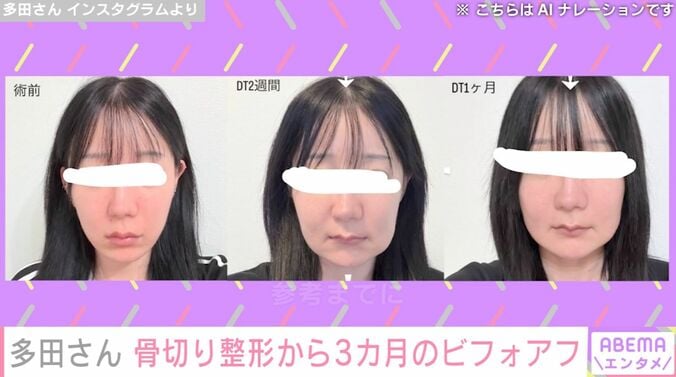 『月曜から夜ふかし』フェフ姉さんの友人・多田さん、両あご&輪郭骨切り整形から3カ月後の姿を公開「感覚はいまだにありません」 3枚目