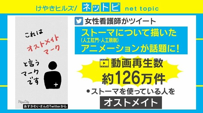 「ストーマ」「オストメイト」に理解を 「わかりやすい」説明動画が話題 1枚目