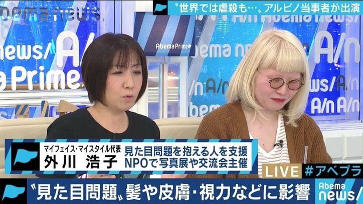 生まれつき色素が薄いアルビノ当事者の苦しみ カラーコードに合わないから バイト 就職を断られるケースも 国内 Abema Times