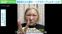ヘアカラーで顔がパンパンに！？ 「顔と頭皮、全部かゆい！」症状と対策は？