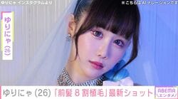 “3歳児ほどのウエスト”ゆりにゃ（26）、「前髪8割植毛」植毛から1年 最新ショット公開