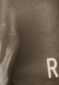 秋野暢子『足の骨折 完治しました。』