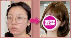 「元乃木坂46与田祐希似」と話題・ニキビ顔→肌治療＆メイク術でアイドルになった美女、ビフォーアフターに驚きの声