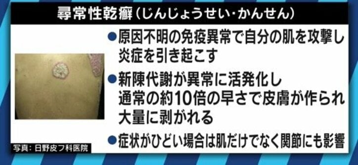 患者が告白「結婚は難しいと言われショックを受けた」 道端アンジェリカも誤解と偏見に苦しむ「乾癬」とは