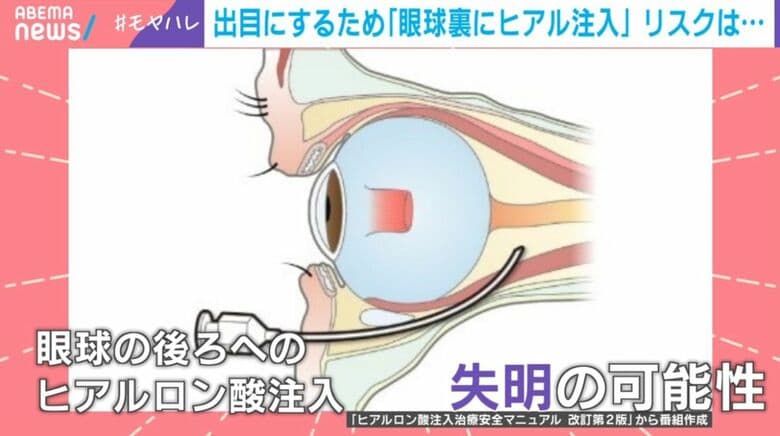 「出目にしたい」“奥目コンプ”で眼球裏にヒアルロン酸注入した女性→ダウンタイムに「目の中に内出血」「あざ引くまで2週間」壮絶体験告白…医師は失明の可能性指摘「あまりにもリスクが大きい」
