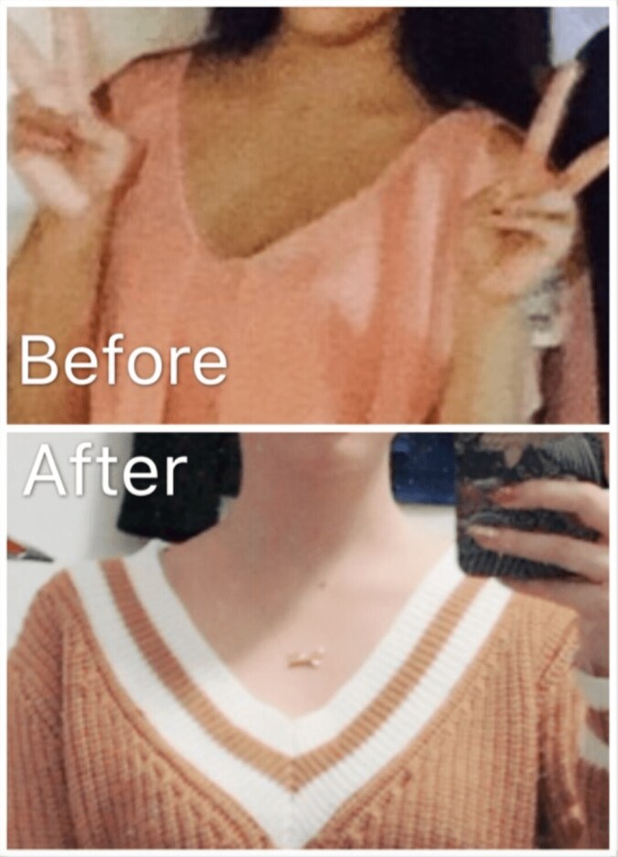 ざわちん、肩にボトックス注射「前より首が長くみえる」 2枚目