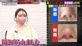 整形総額4000万円の美女、小鼻縮小手術での失敗を告白「自分のカウンセリング周り不足」後悔を語る