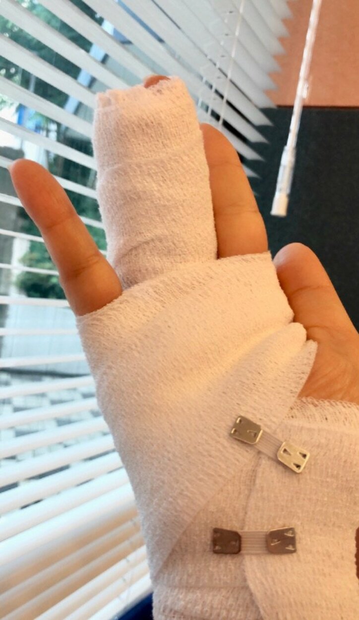 秋吉久美子、右手の薬指を骨折「入院したい、、。」 1枚目