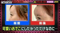 “若返り注射”で整形失敗「どんどんおでこが大きく…」54歳美女が明かした整形＆修正手術体験
