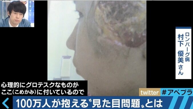 実は100万人が抱える“見た目問題” 当事者たちの生きづらさとは 3枚目