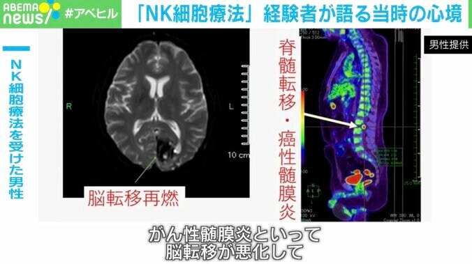 NK細胞療法を受けた男性、状態が悪化