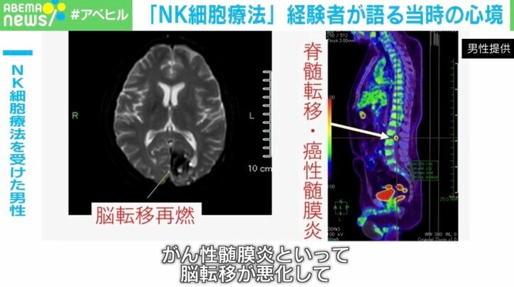 NK細胞療法を受けた男性、状態が悪化