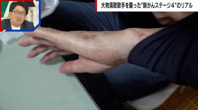 副作用に苦しむ山川豊