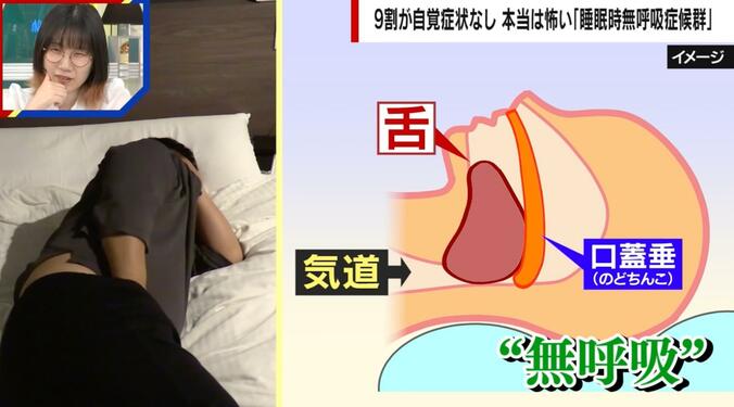 睡眠時に気道が閉塞する状態