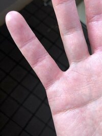 狩野英孝、アトピーとアレルギーで荒れた指の治療経過を公開「小指がパックリ」