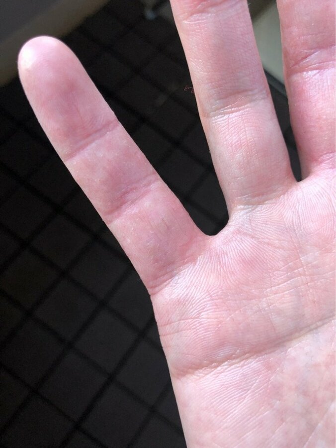 狩野英孝、アトピーとアレルギーで荒れた指の治療経過を公開「小指がパックリ」 1枚目