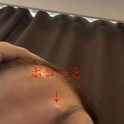  だいたひかる、眉毛の上にできたしこりを切除「気になっている事は、早めに対処した方が」 