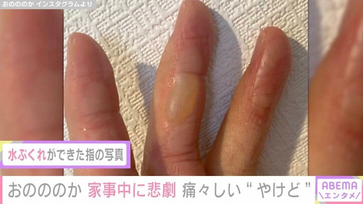 おのののか、家事中に悲劇…痛々しい患部を公開「１時間以上経っても痛みがすごい」