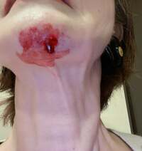 小柳ルミ子『怪我』